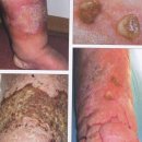 Ulcere linfostatiche